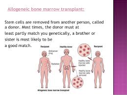 Allogeneic bone marrow transplant