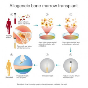 Allogenic bone marrow transplant