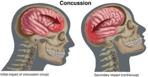 Concussion - Hyperbarics Sun Valley