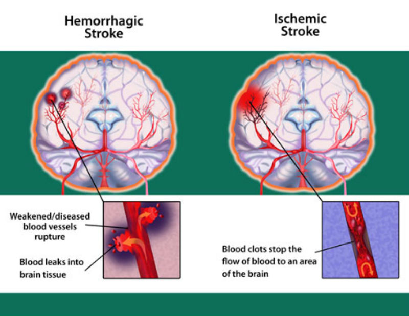 Types of stroke - Hyperbaric Sun Valley